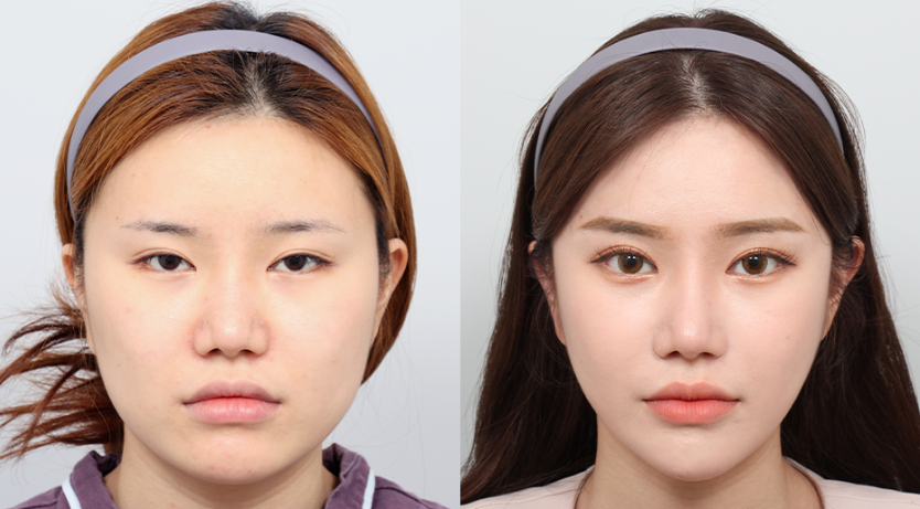 Extreme transformations through plastic surgery are normalized in South Korea